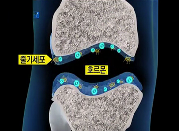 神奇的膝关节干细胞软骨修复